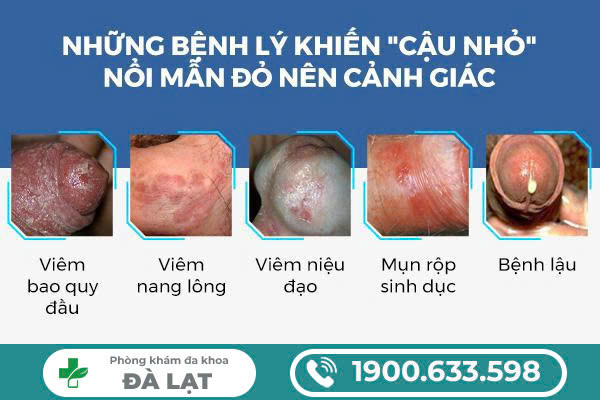 Hình ảnh minh họa